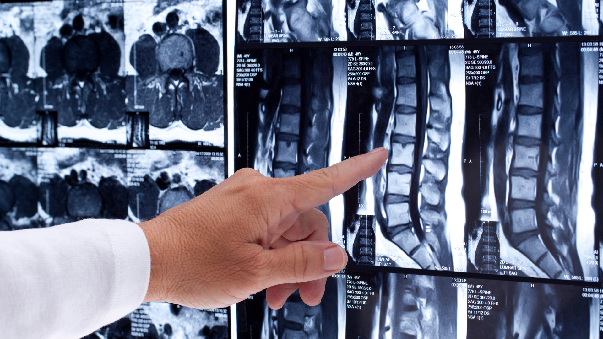 A doctor is pointing at an x-ray of the spine.