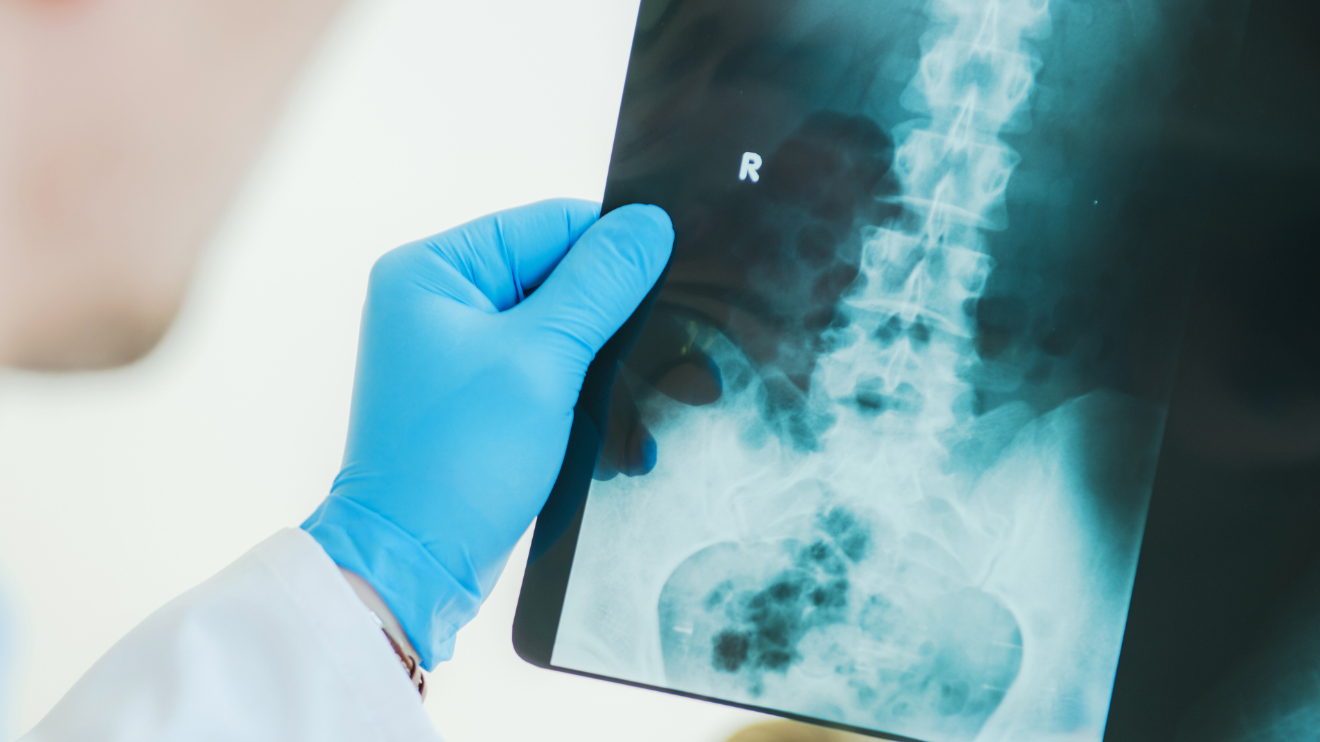 A doctor is holding an x-ray of a person 's spine.