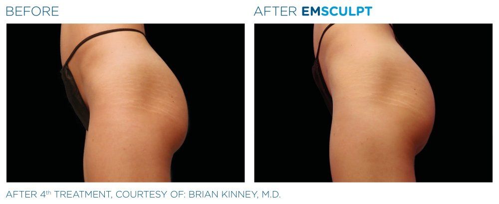 coolsculpting vs emsculpt neo
