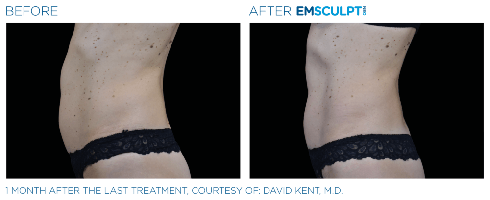 NYC Emsculpt Neo vs Evolve