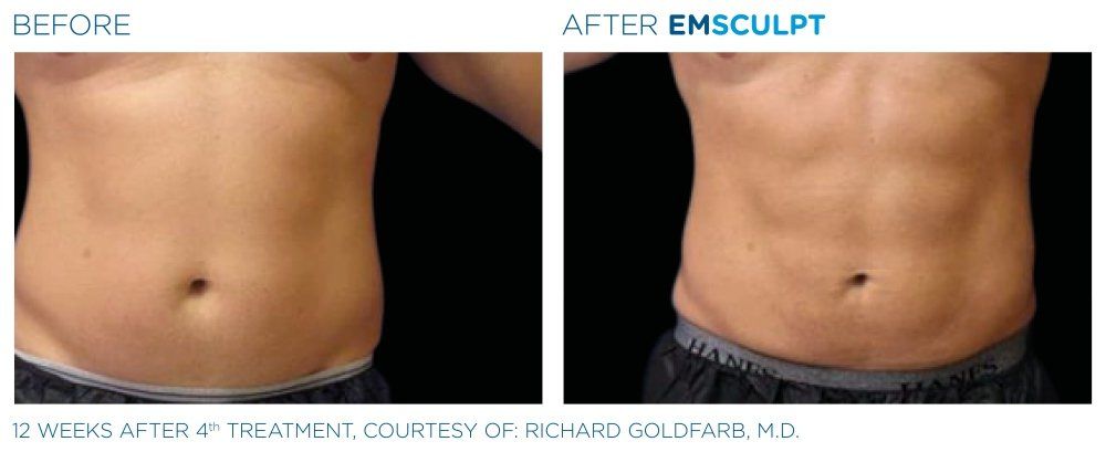 emsculpt neo compared to coolsculpting