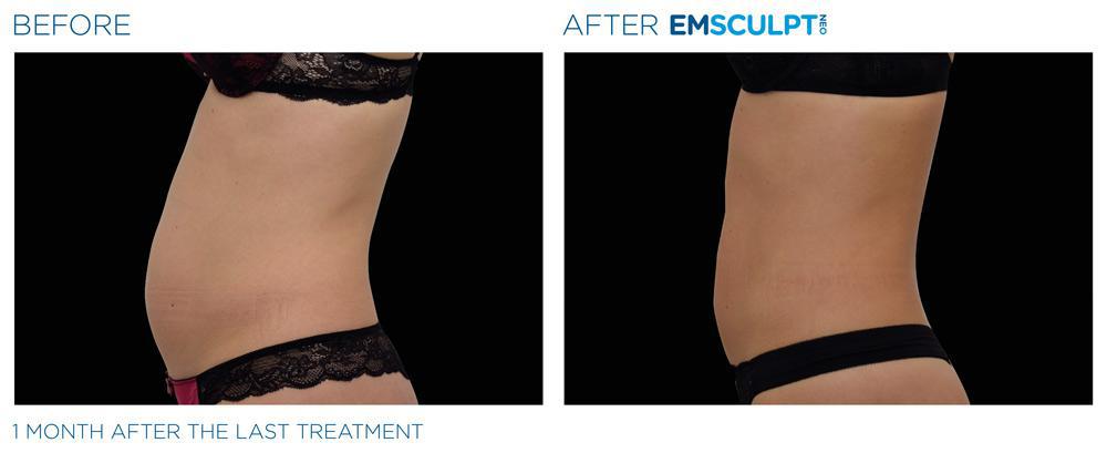 emsculpt neo before and after images