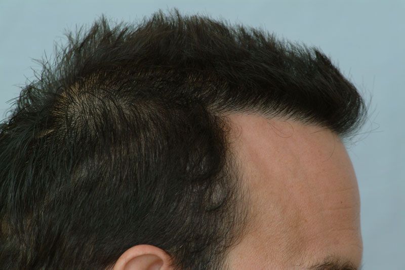 Forhair Hair Transplant Results Patient DRS