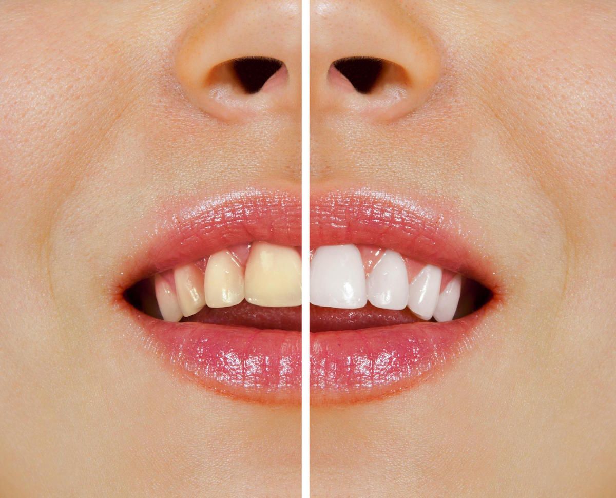 Before And After Teeth Whitening — Melbourne, VIC — DonEast Dental