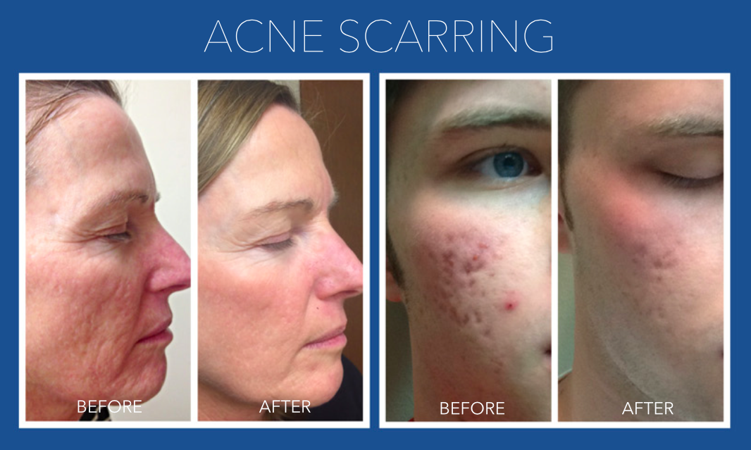 Acne Scarring Positive Result — Indianapolis, IN — Interface Aesthetic Surgery Group