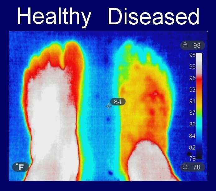 Image of Healthy and Diseased nerve in the foot