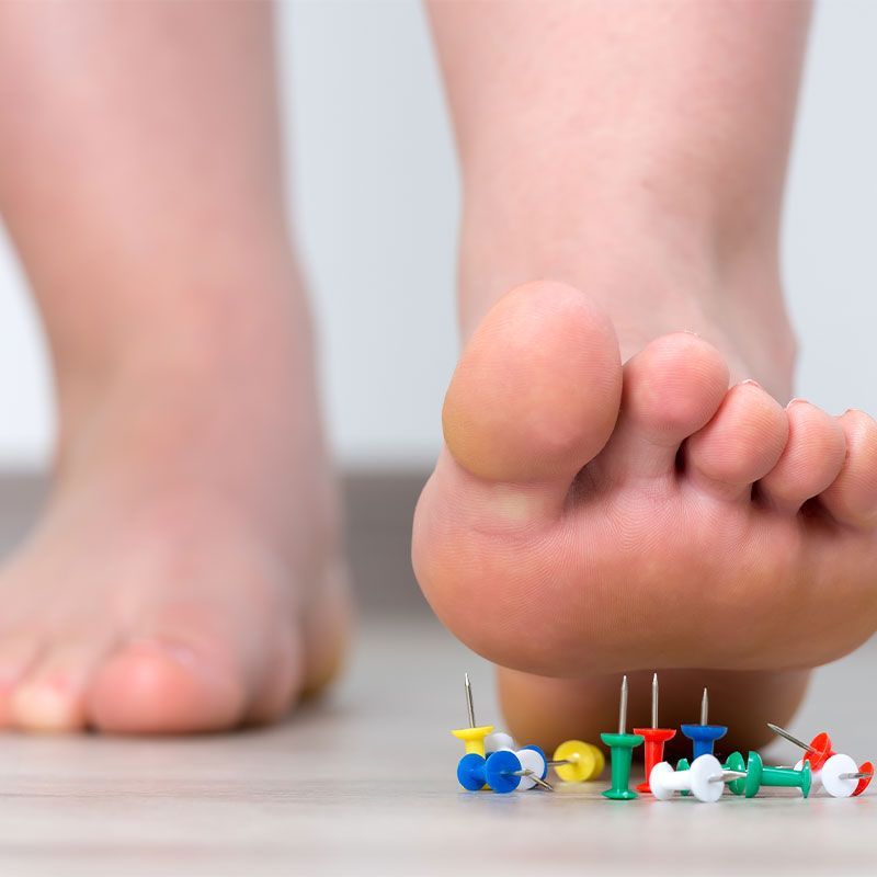 A close up of a person 's foot with pins sticking out of it