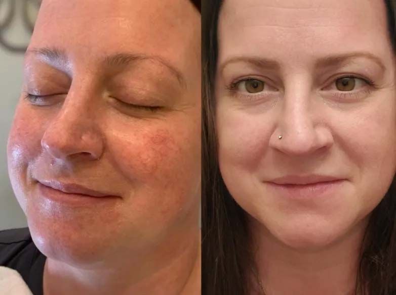 Person's face showing before and after microneedling with PRP Treatment