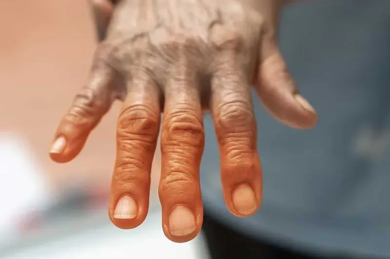 A close up of an older person 's hand with arthritis.