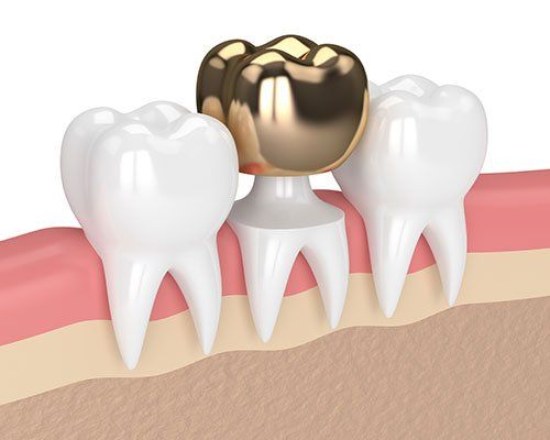 Amazing Gold Teeth — Teeth with Gold Fillings in Baker, LA