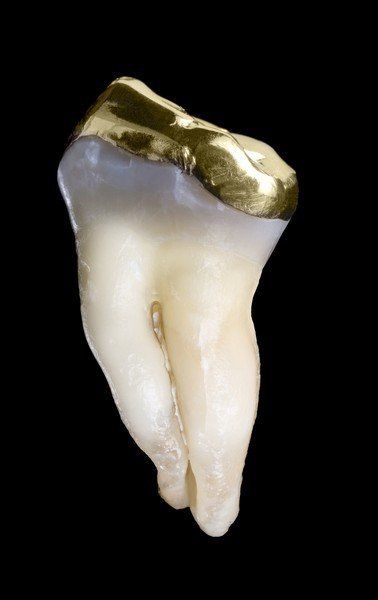 Gold Teeth — Teeth with Gold Fillings in Baker, LA
