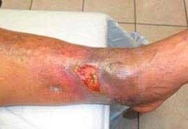 SANA PIE DIABETICO - complicaciones del pie diabético