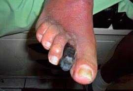 SANA PIE DIABETICO - atención de heridas de pie diabético