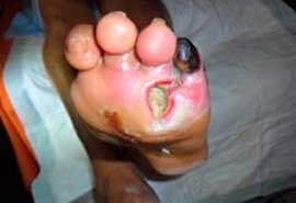 SANA PIE DIABETICO - valoración de heridas del pie diabético