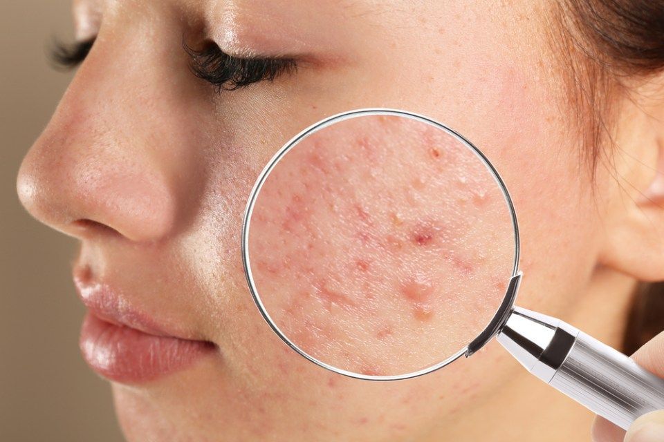 girl with acne problem visiting dermatologist
