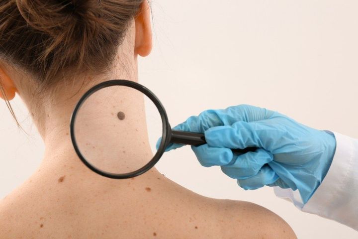 Dermatologist examining moles of patient 