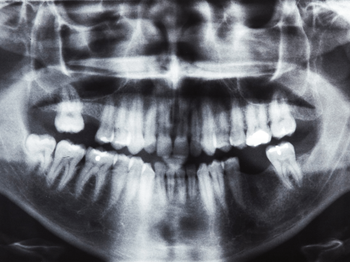 Oral Surgery - Lawrence, KS - JayHawk Dental