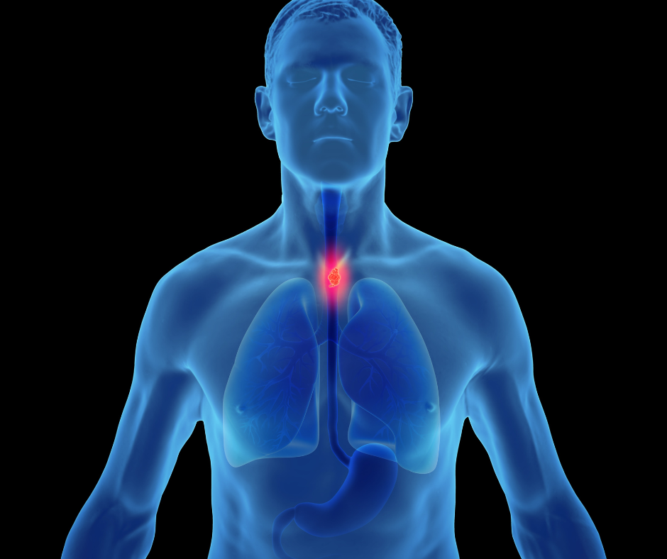 Esophageal Cancer | Service Page | LA Cancer Network