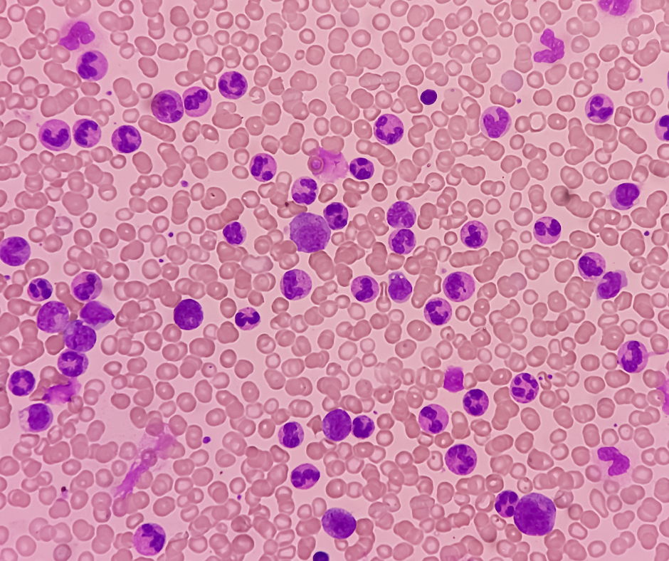 Leukemia | Service Page | LA Cancer Network