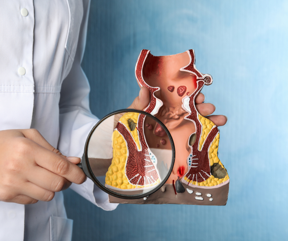 Anal Canal Cancer | Service Page | LA Cancer Network