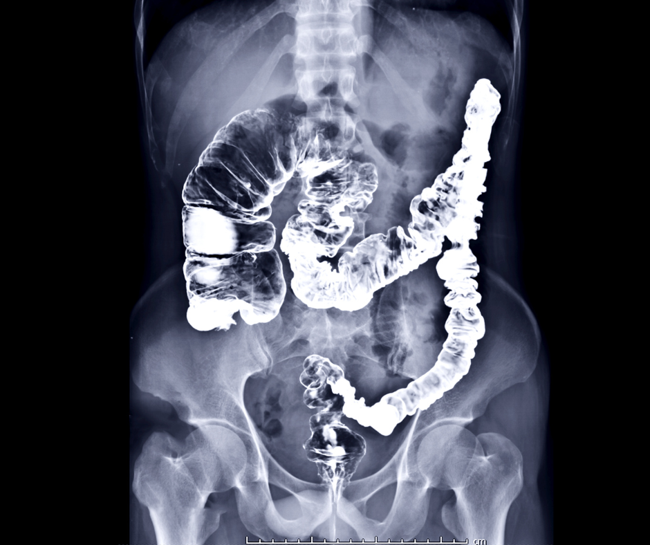 Appendix Cancer | Service Page | LA Cancer Network