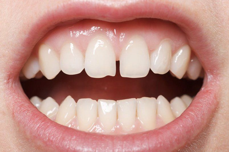 A close up of a person 's teeth with their mouth open.