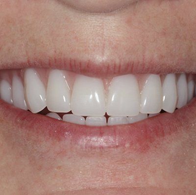 A close up of a woman 's smile with white teeth.