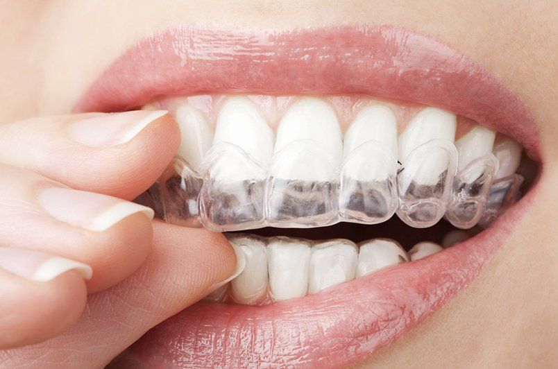 A woman is putting a clear brace on her teeth.