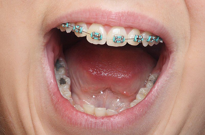 A close up of a person 's mouth with braces on their teeth.