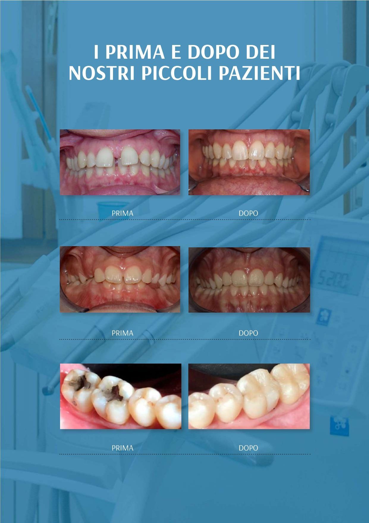 A picture of a person 's teeth with the words 1 prima e dopo dei nostri piccoli pazienti