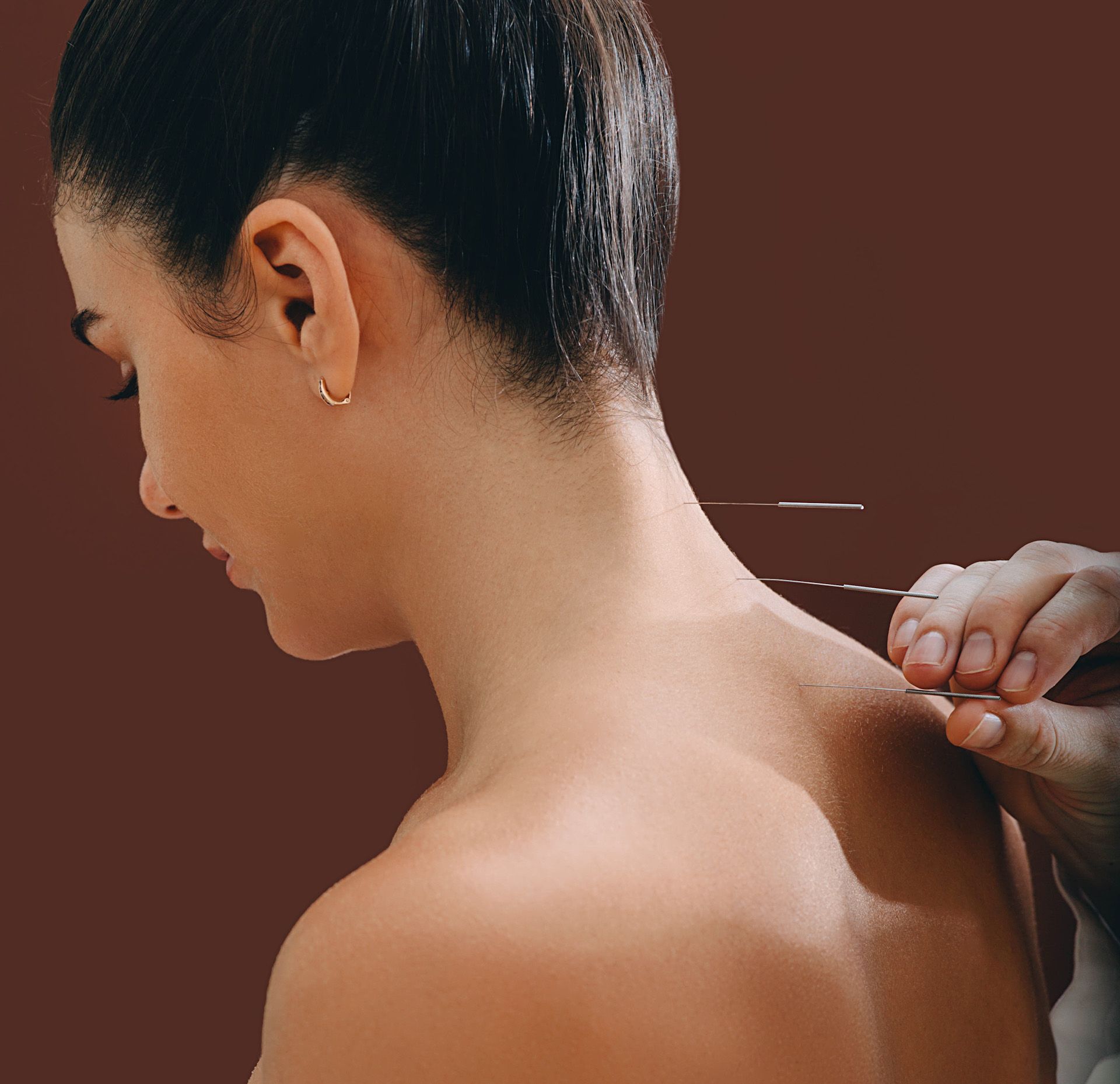 A woman is getting acupuncture on her back