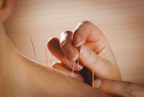 Young woman getting acupuncture