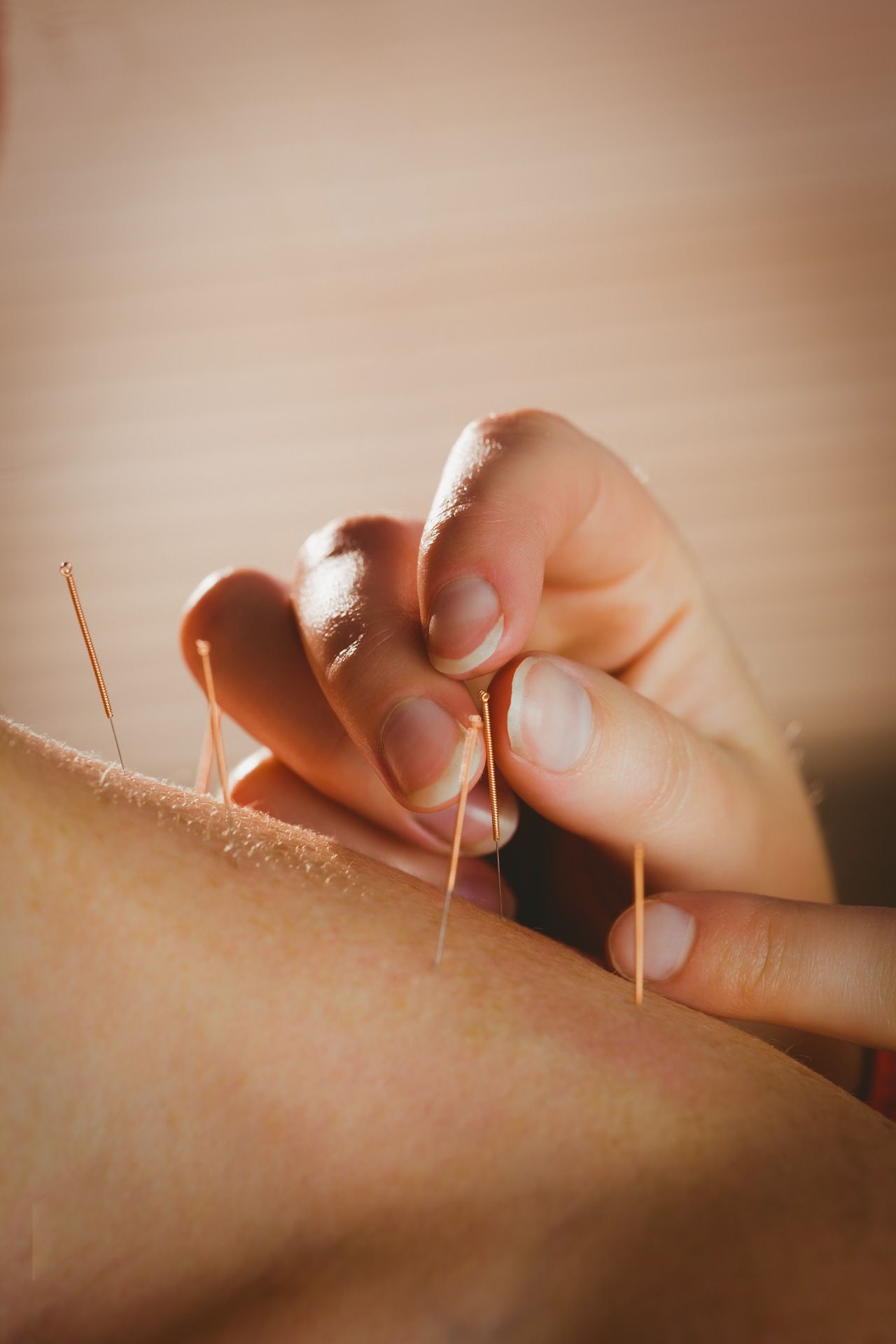 A person is getting acupuncture on their arm.