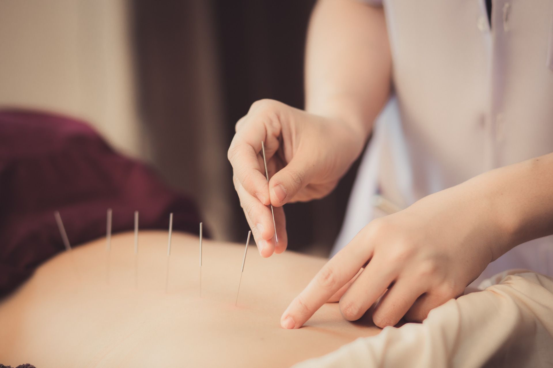 A person is getting acupuncture on their back.