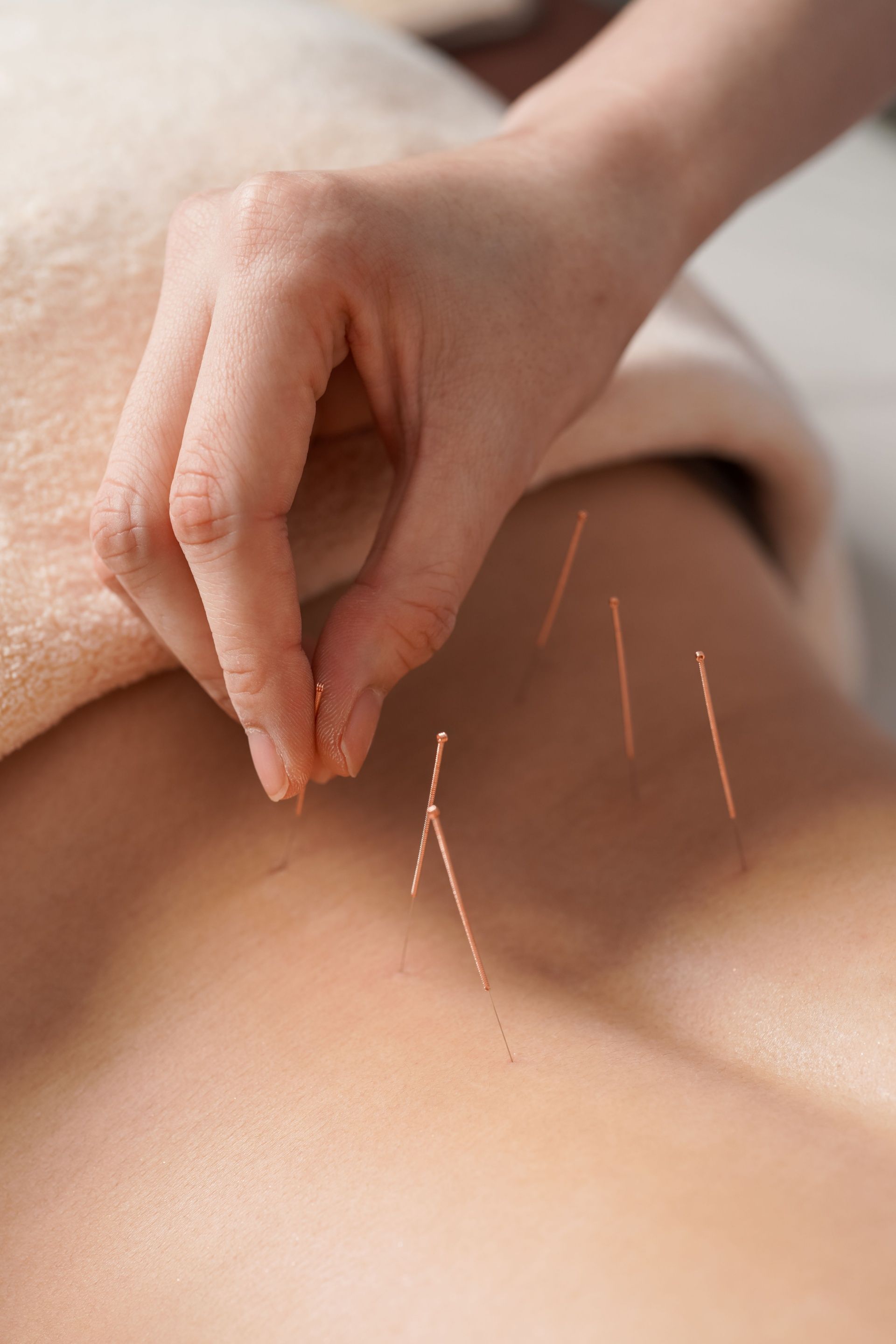 A person is getting acupuncture on their body.