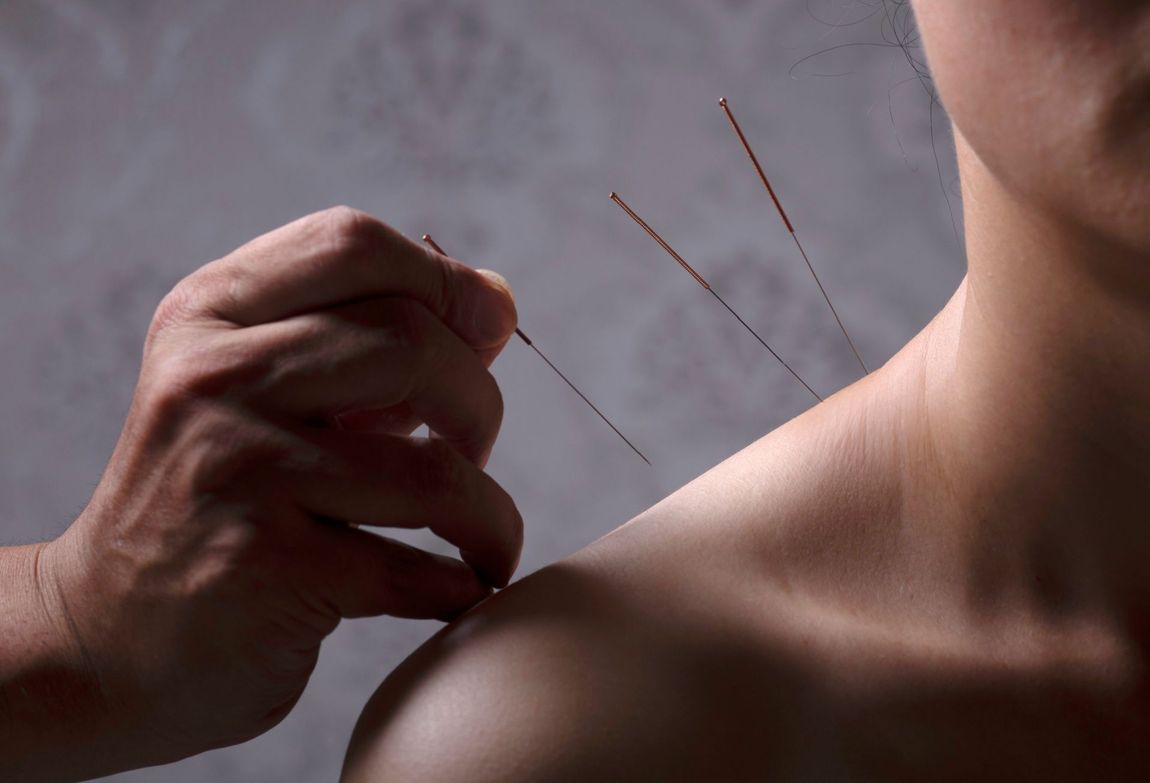 A person is getting acupuncture on their shoulder.