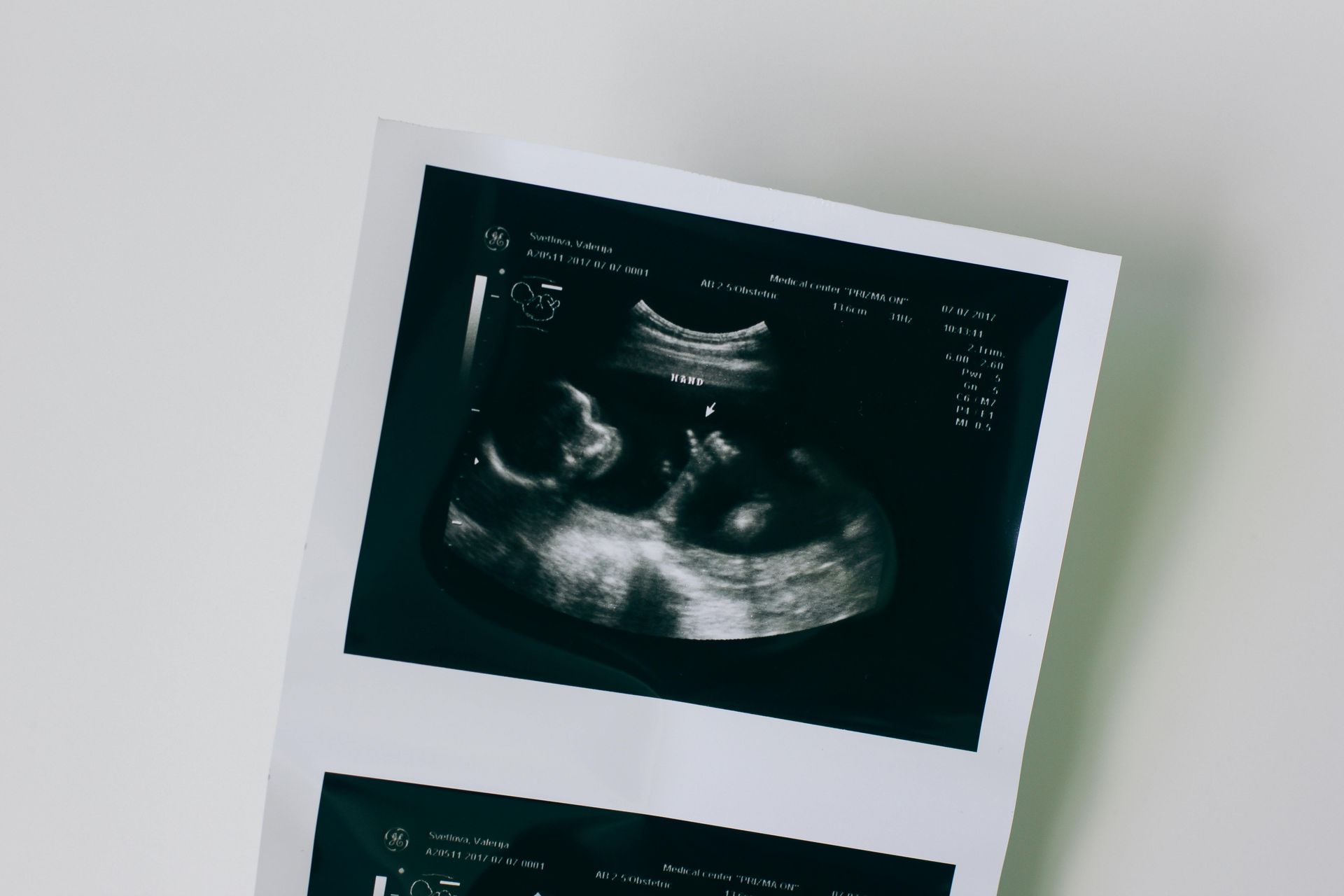A close-up view of a printed medical ultrasound scan showing a fetal silhouette in black and white.