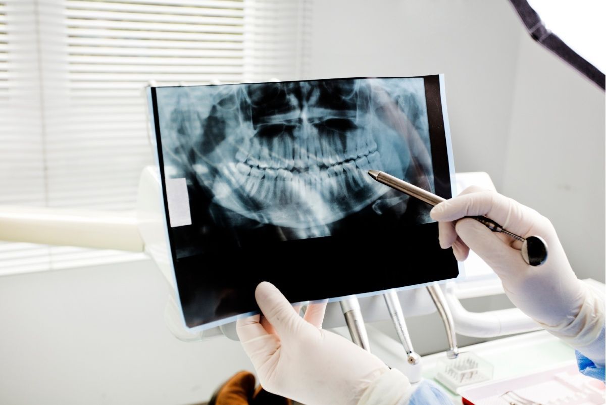 Dentist pointing at dental X-ray of teeth. Hands wearing gloves. Setting is a dental office.