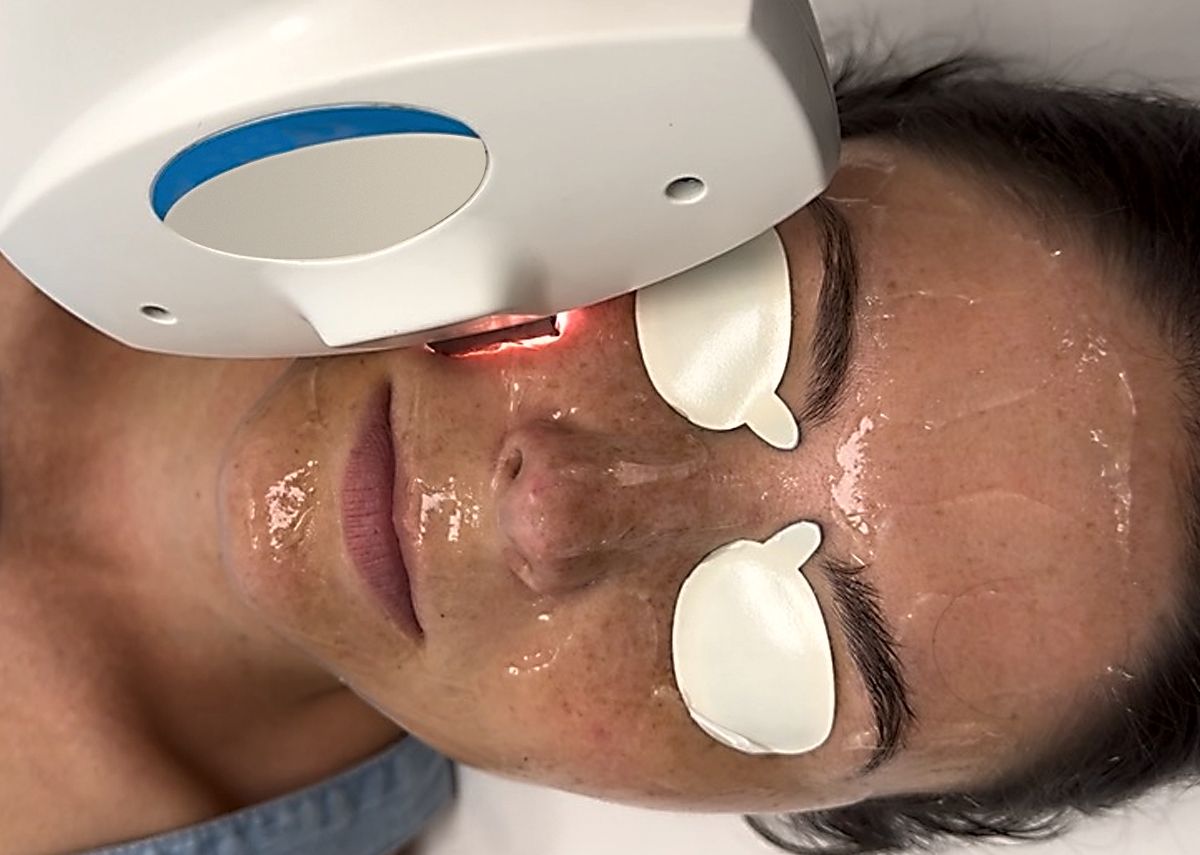 A woman is getting an IPL treatment on her face.