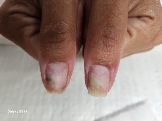 A close up of a person's nails with black spots on them — Nailz By Dezign In Proserpine, QLD