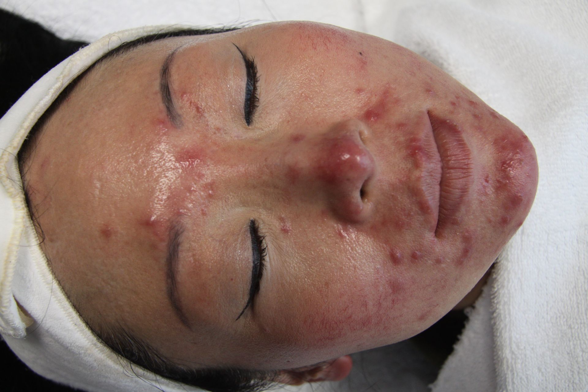A woman with acne on her face is laying down with her eyes closed.