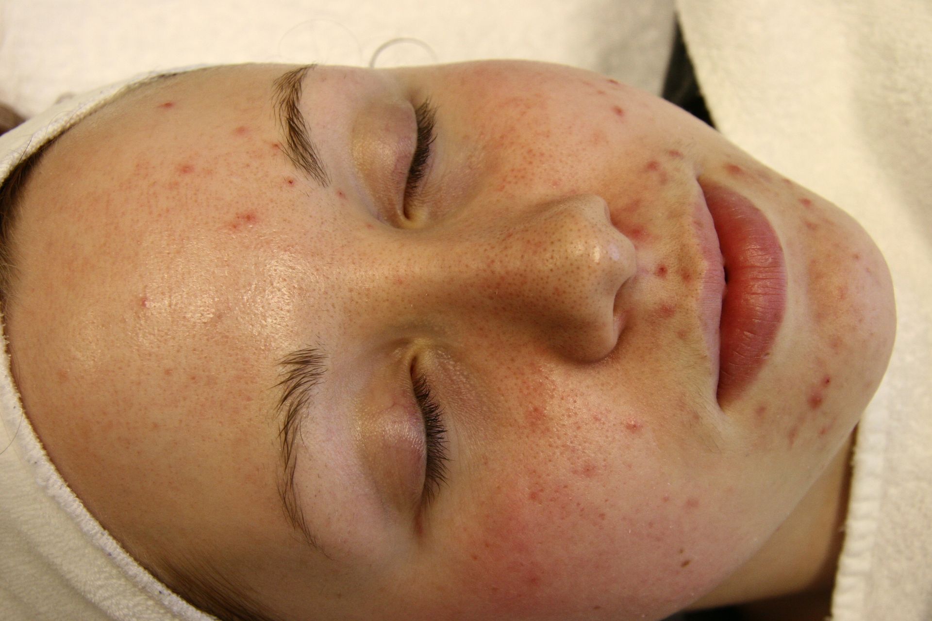 A woman with acne on her face is laying down with her eyes closed.