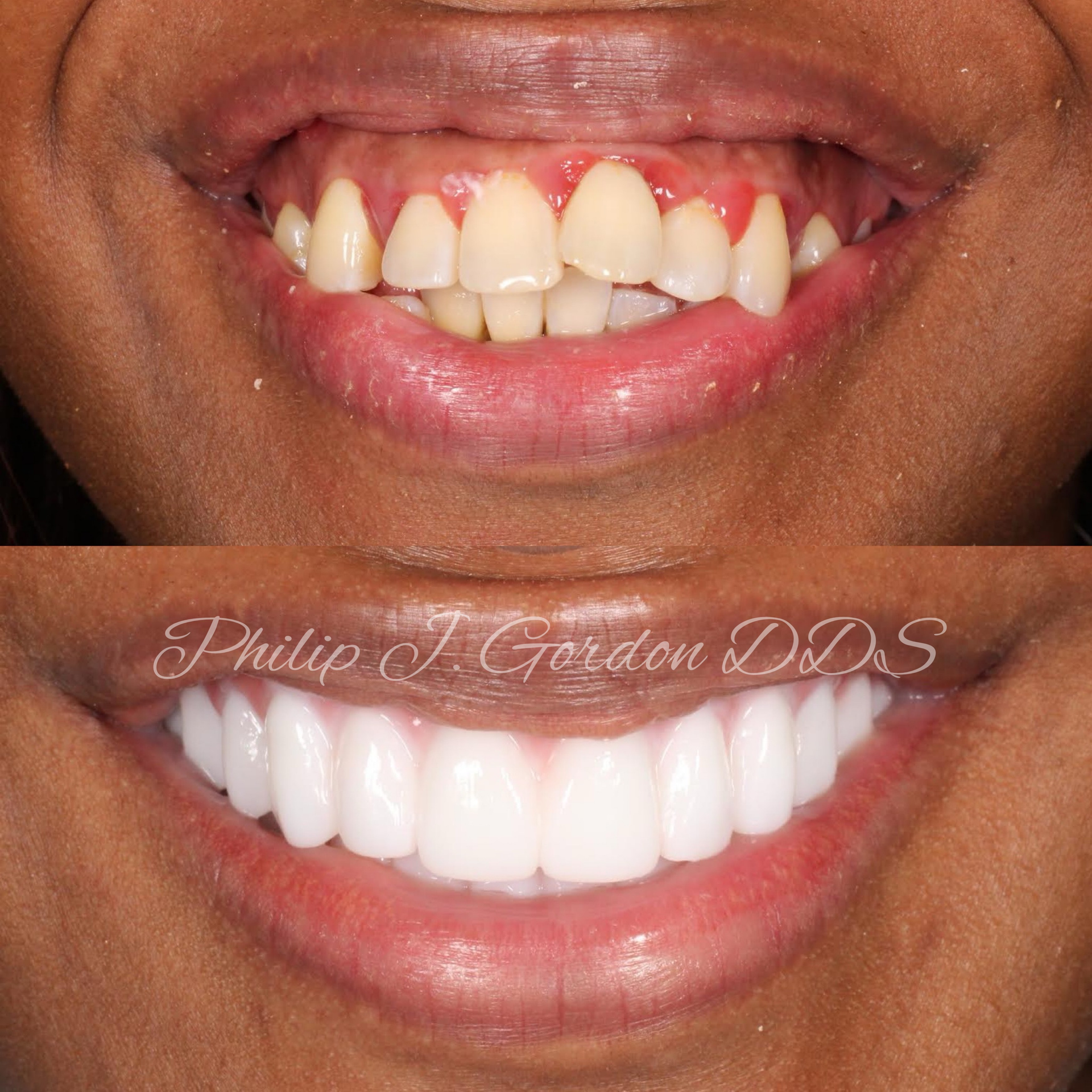 A before and after photo of a woman 's teeth by philip j gordon dds