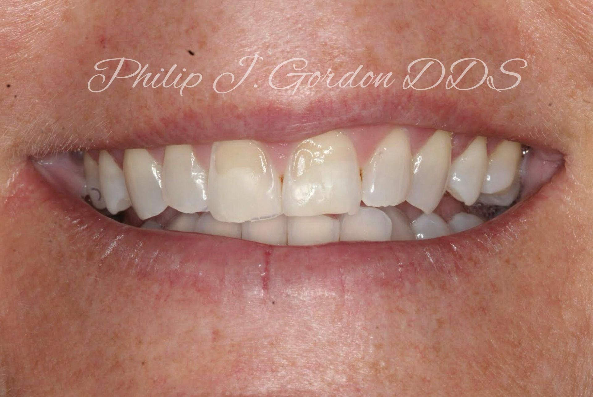 A close up of a woman 's teeth with the name philip j gordon dds written on the bottom.