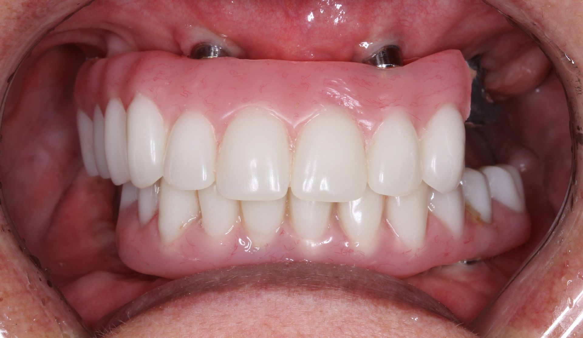 A close up of a person 's mouth with a full denture.