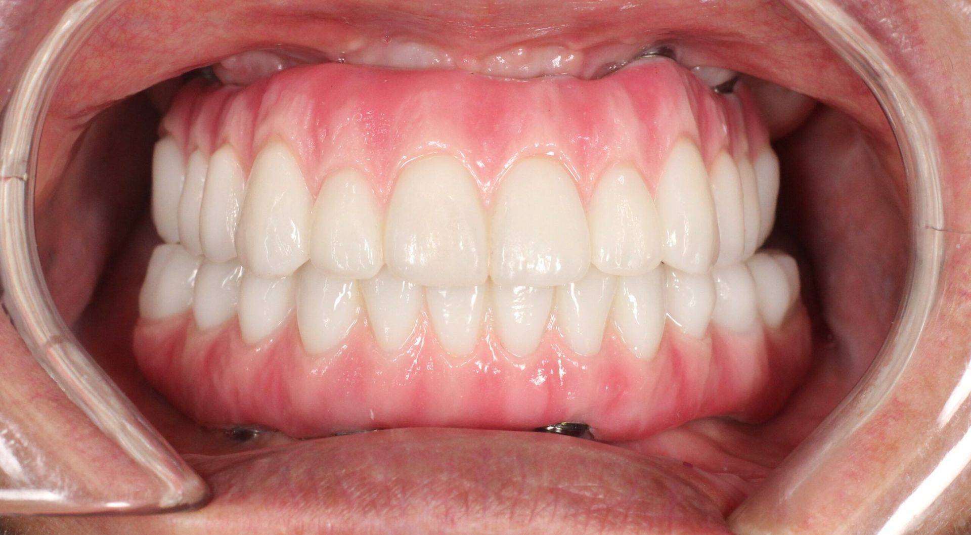 A close up of a person 's teeth with a clear brace.