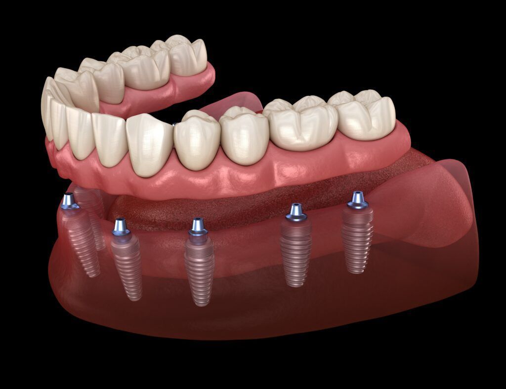 A computer generated image of a full denture with dental implants.