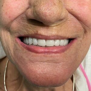 A close up of a woman 's smile with white teeth.