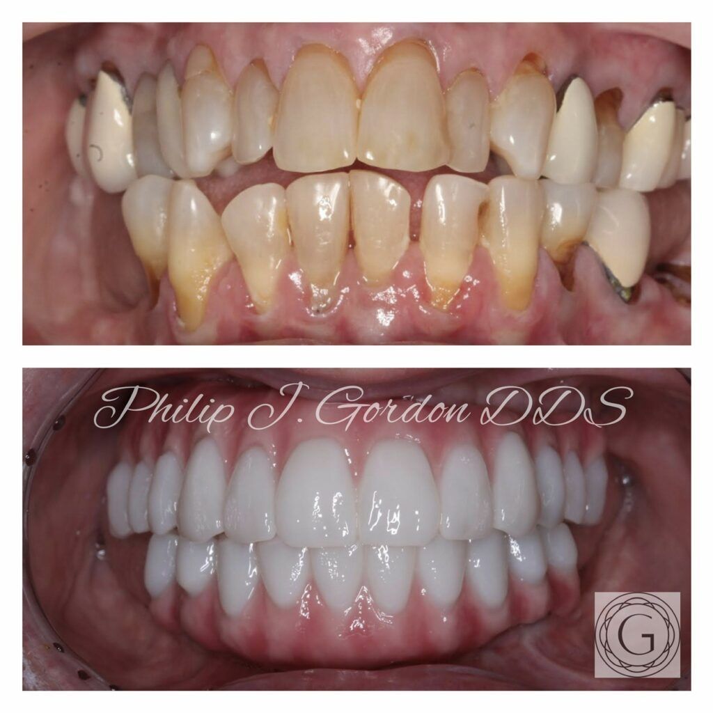 A before and after photo of a person 's teeth by philip j gordon dds