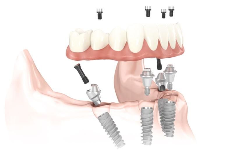 A computer generated image of a person 's teeth and dental implants.